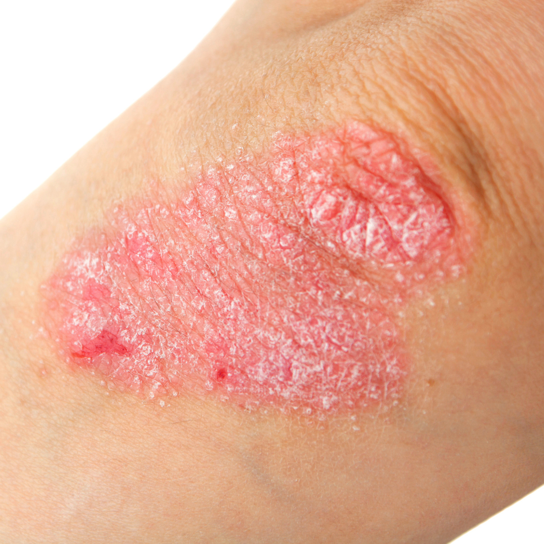 Eczema Flare-Up: Here’s How To Keep Symptoms Under Control?