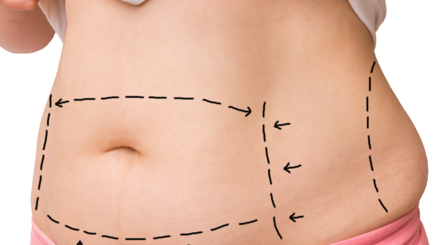 How to Get the Best Results from Liposuction
