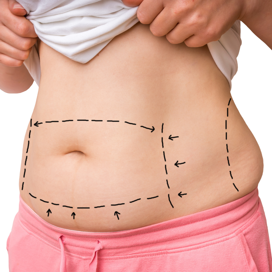 How to Get the Best Results from Liposuction