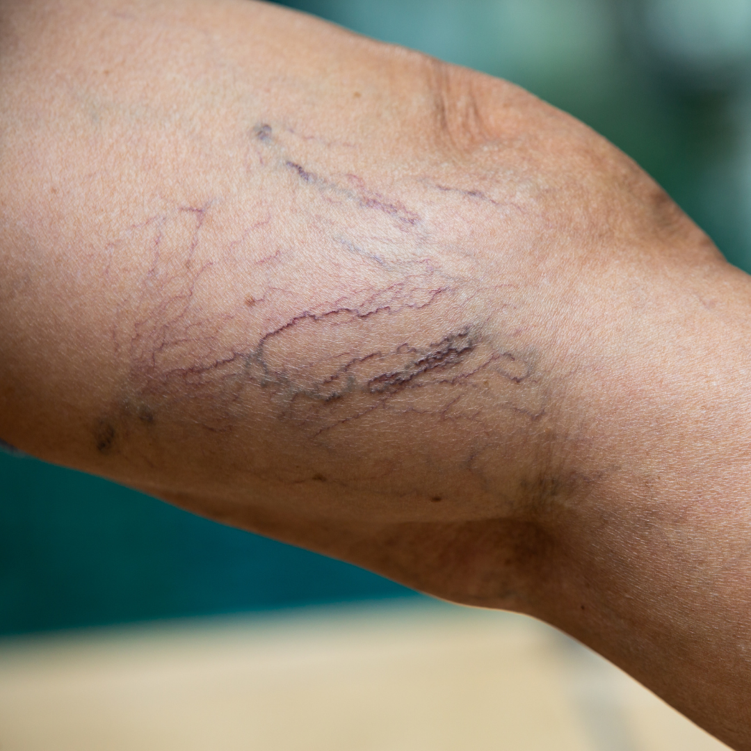 Things to know about vein disorders?