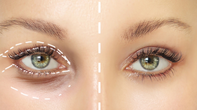 What Should You Do Before Having Eyelid Surgery?