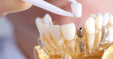 Reasons To Get Dental Implants