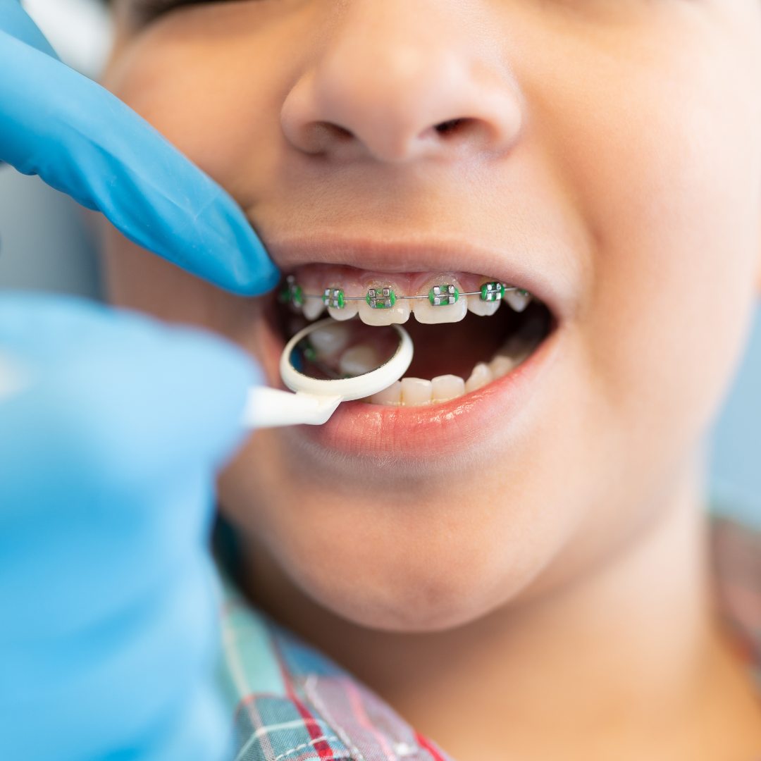 Helping Your Child Deal with Braces