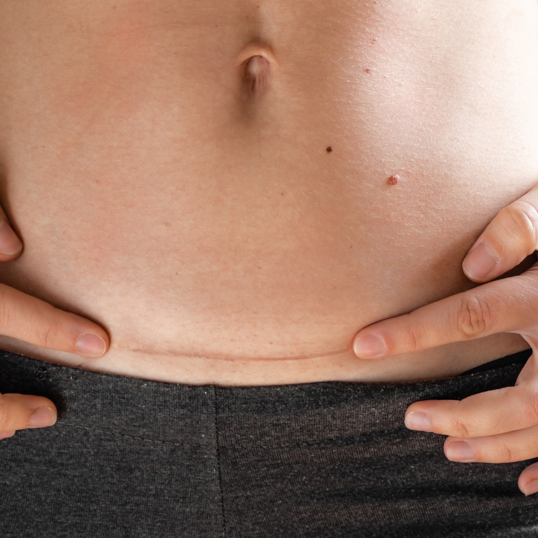 Things to Know about Tummy Tuck Surgery