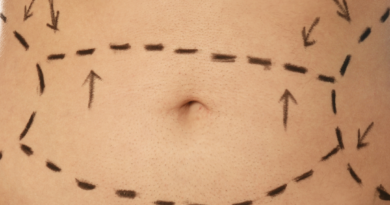 Things to Know about Tummy Tuck Surgery